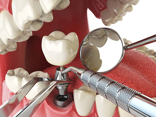 Best Broken or Chipped Tooth Repair in White Plains, NY